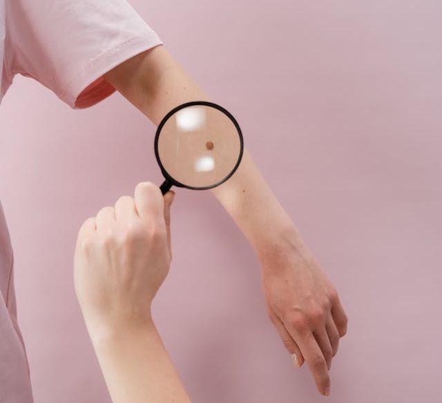 Hautkrebs - Melanom am Arm